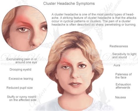 13 Common Causes of Headache Behind Left Eye