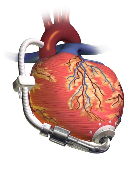 The Rise of the LVAD and the Fall of the eGFR: A Commentary on LVAD ...