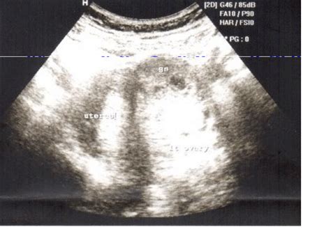 Ultrasound showing interstitial pregnancy | Download Scientific Diagram