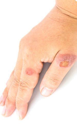 Home Remedies for Burn Blisters (With images) | Home remedies for burns ...