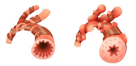 New Observations Made in Asthma-COPD Overlap Syndrome (ACOS) Patients