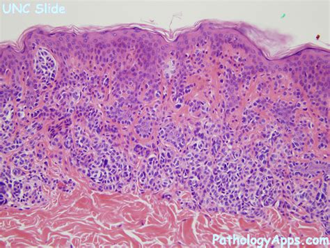 benign melanocytic nevus pathology