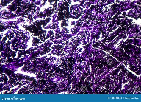 Histopathology of Silicosis, Light Micrograph Stock Photo - Image of microphotograph, micrograph ...