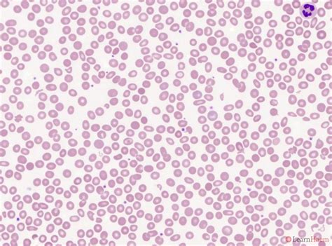 Basophilic Stippling Thalassemia