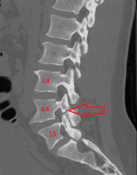 The Complete Guide to Spondylolysis and Spondylolisthesis