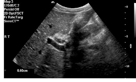 Ultrasonography (US) digital image of the CBD measurement. | Download Scientific Diagram