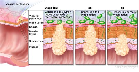 Colon Cancer Stages Symptoms