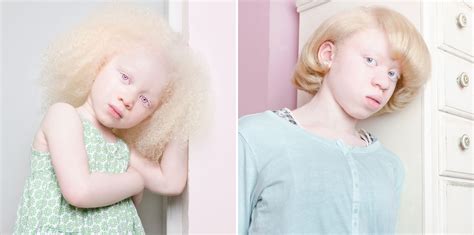 These 12 Photos of People With Albinism Will Take Your Breath Away