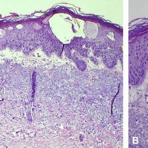 Histopathology shows spongiotic dermatitis with marked papillary dermal... | Download Scientific ...