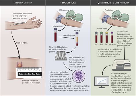 How Do I Navigate Latent Tuberculosis Diagnosis? | NEJM Evidence