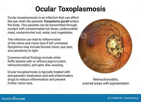 Ocular Toxoplasmosis, Retinal Scar Caused By A Toxoplasma Gondii Infection, Scientific ...