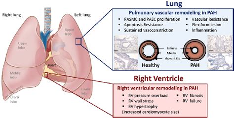 Pathogenesis of pulmonary hypertension. PAH is associated with vascular... | Download Scientific ...