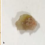 a Eruptive vellus hair cyst: in vivo dermoscopy showing hyperpigmented... | Download Scientific ...