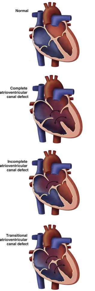 Atrioventricular Canal Defects | Radiology Key