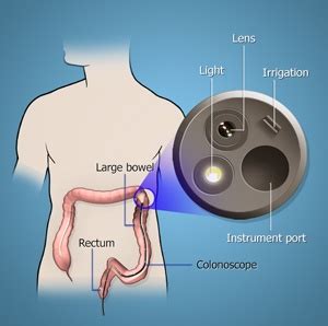 Flexible Sigmoidoscopy The Woodlands | Abdominal Pain The Woodlands