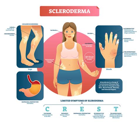 Scleroderma Skin Symptoms