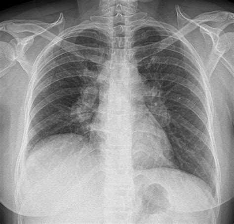 Tuberculous mediastinal lymphadenopathy in an adult -- Iyengar et al ...