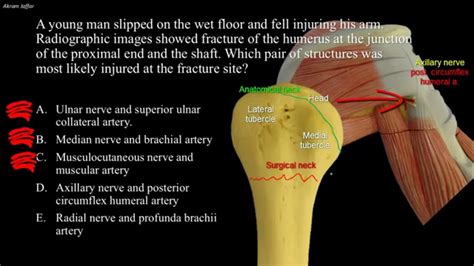 Fractures of the humeurs and possible nerve injuries - YouTube