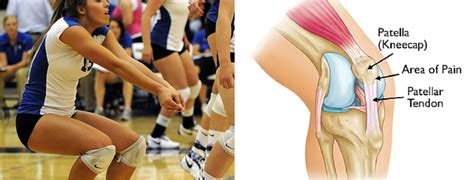 What You Need to Know About Patellar Tendinitis - Dr. Andrew Dahlgren M.D.