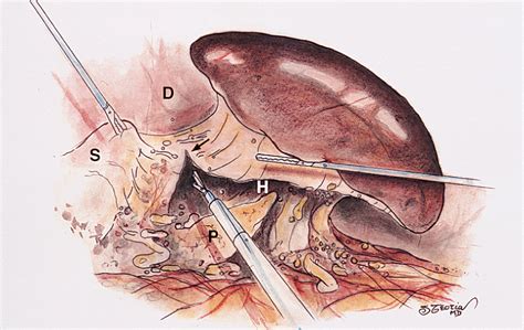 Laparoscopic Splenectomy | Minimally Invasive Surgery | JAMA Surgery | The JAMA Network