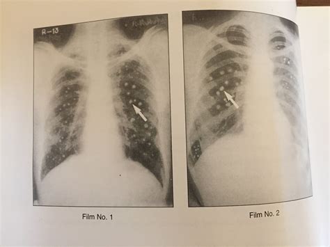 XRAYS OF PULMONARY CALCIFICATION