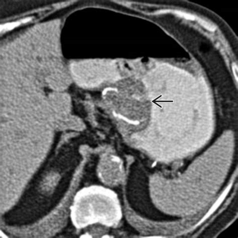 Fundoplication Complications | Clinical Gate