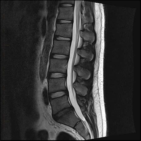 MRI of the Lower Back | Melbourne Radiology