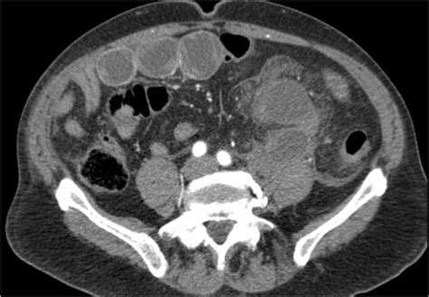 The Radiology Assistant : Closed Loop Obstruction in Small bowel obstruction | Small bowel ...