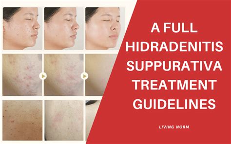 A Full Hidradenitis Suppurativa Treatment Guidelines - Living Norm