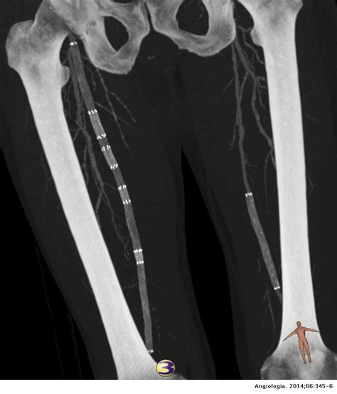 ¿Hay límites para el stent femoral? | Angiología