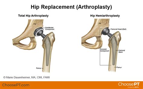 Guide | Physical Therapy Guide to Total Hip Replacement (Arthroplasty ...