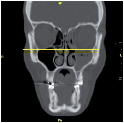 In the coronal section, opacification and atelectasis of the left ...