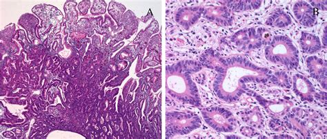 Gastric Cancer