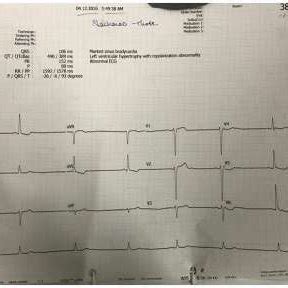 ECG showing marked sinus bradycardia (38 bpm) following carotid sinus... | Download Scientific ...