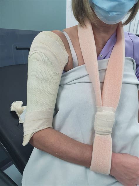 Humeral brace – Plaster Room