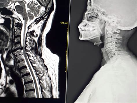 l'IRM du rachis cervical montre une compression modérée de la moelle épinière c4-c5 15763181 ...