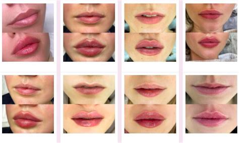 Lip Filler Before and After Photos and Results - the daily glimmer