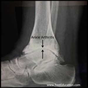 Ankle Arthritis - FootEducation