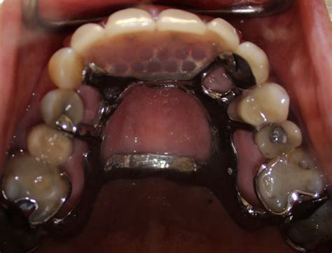 Partial Dentures (plates)