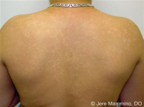 Tinea Versicolor - American Osteopathic College of Dermatology (AOCD)