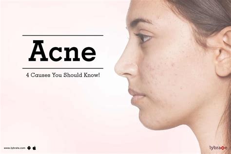 Acne - 4 Causes You Should Know! - By Dr. Deepak Sharma | Lybrate