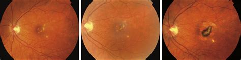 Punctate Inner ChoroidopathyClinical Features and Outcomes | Ophthalmology | JAMA Ophthalmology ...