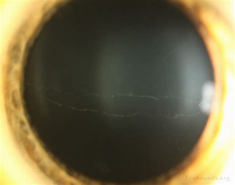 Atlas Entry - Posterior Polymorphous Corneal Dystrophy (PPMD)