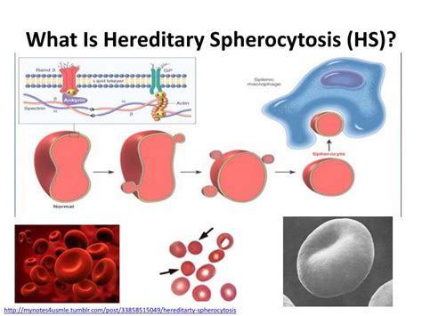 PPT - Hereditary Spherocytosis PowerPoint Presentation - ID:2117076