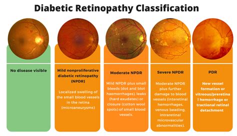 Diabetic Retinopathy classification - MEDizzy