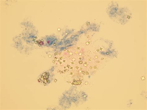 Amorphous Phosphate Crystals In Urine