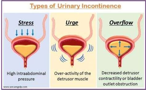 Urinary Incontinence (UI): Classification, Management - We Care