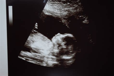 Following The Kies Family: 19 week Ultrasound...........