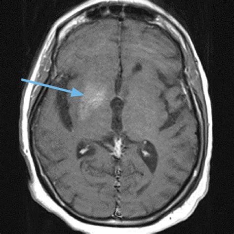 MRI brain with contrast, in this case, at the time of presentation with ...