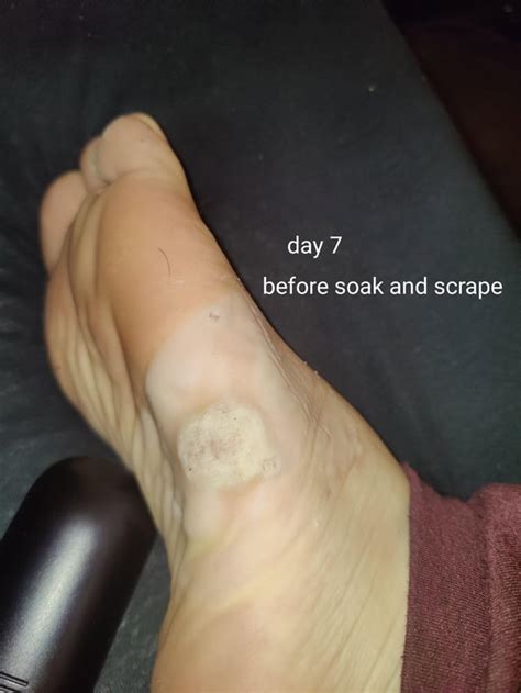 Plantar wart duct tape progress. : r/Warts